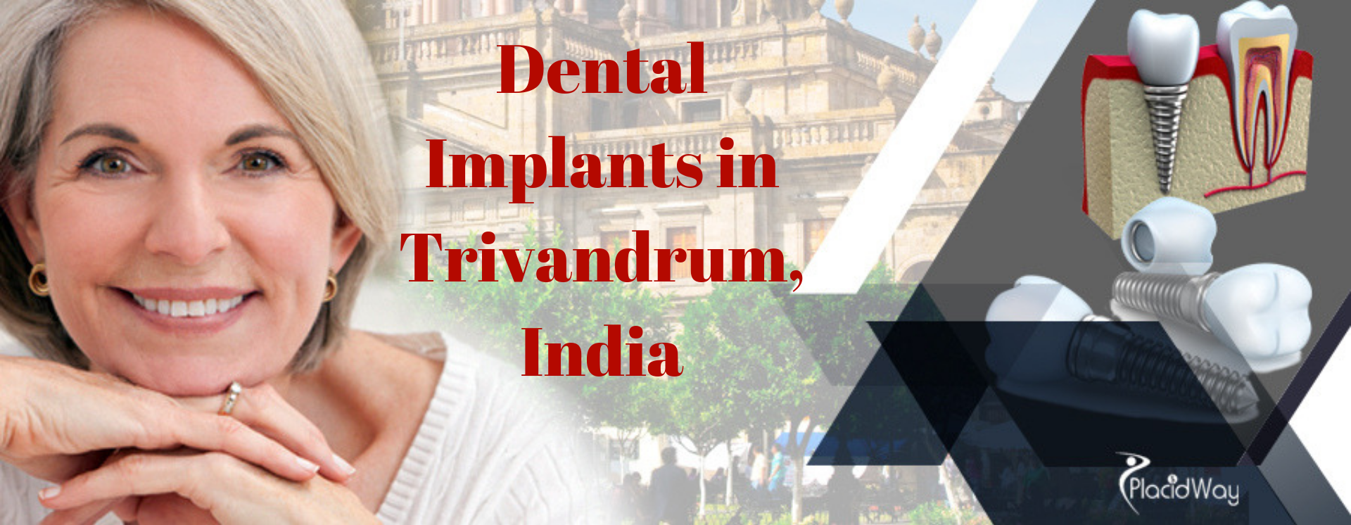 Dental Implants in Trivandrum, India
